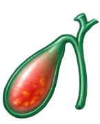 COLECISTITIS